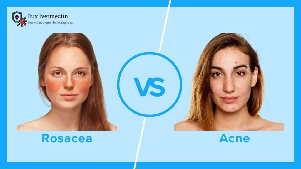 Rosacea vs. Acne